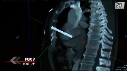 Un clou en plein coeur, Il survit.