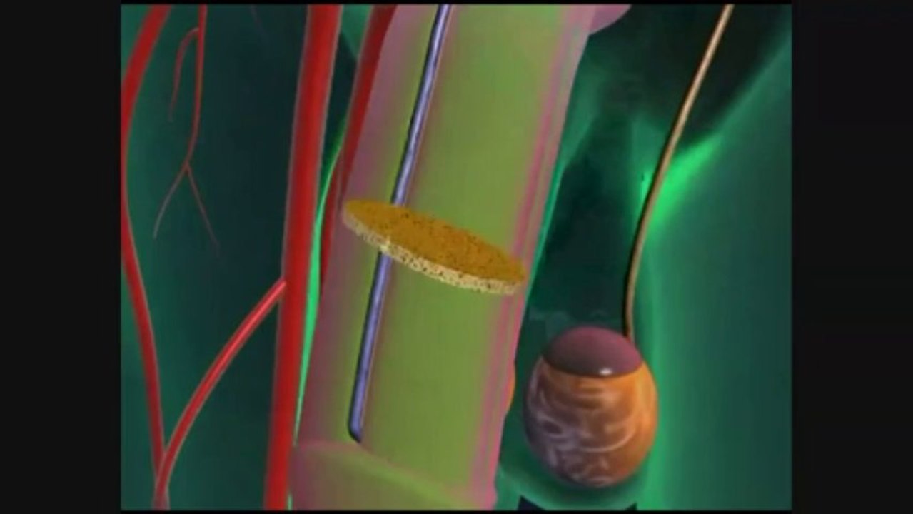 What is Erectile Dysfunction? by Urologist in Tampa