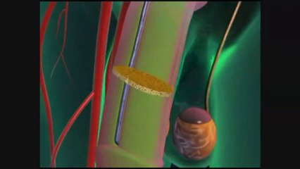 What is Erectile Dysfunction? by Urologist in Tampa