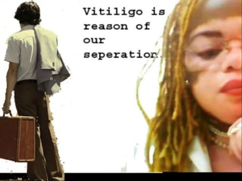 How to Cure Vitiligo Fast Naturally - How to Get Rid of Vitiligo Fast