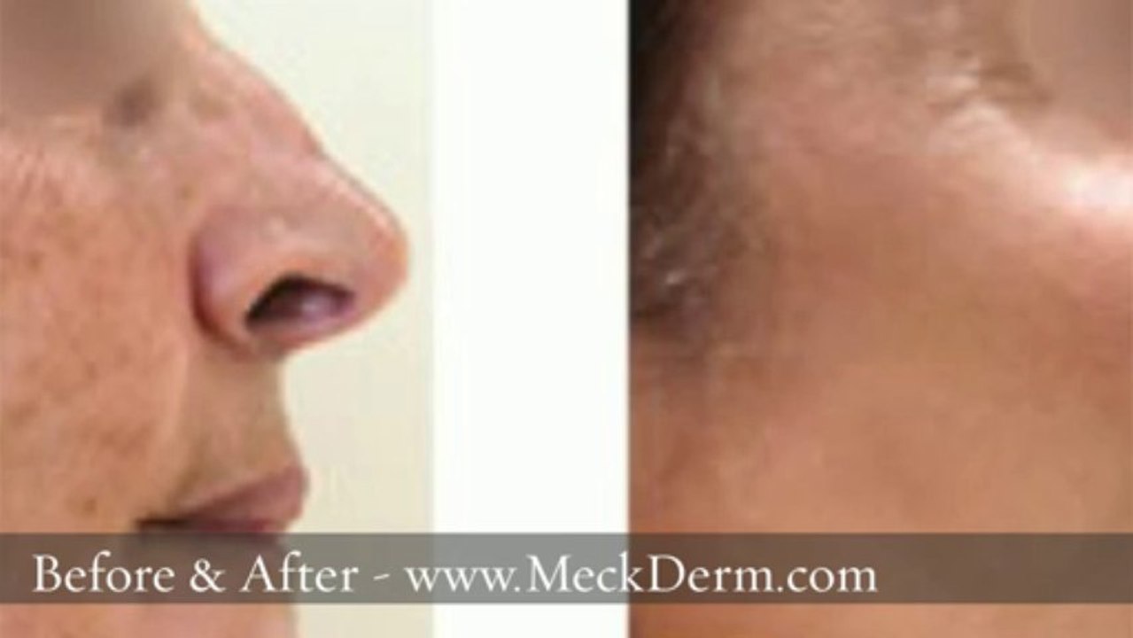 Skin Cancer Removal Charlotte NC 704-344-8846