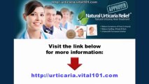 How To Get Rid Of Hives Naturally - Natural Cure For Hives - Urticaria And Angioedema Treatment