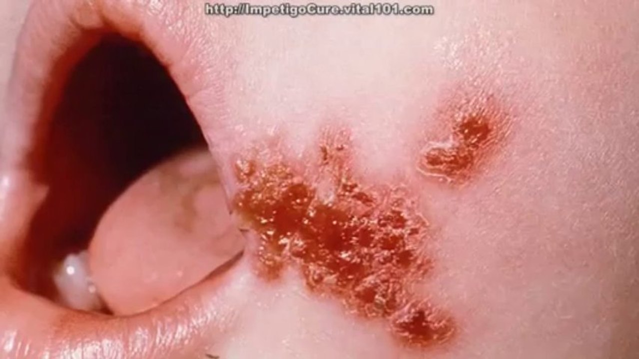 Natural Treatment For Impetigo - How To Cure Impetigo At Home - Home Remedies For Impetigo