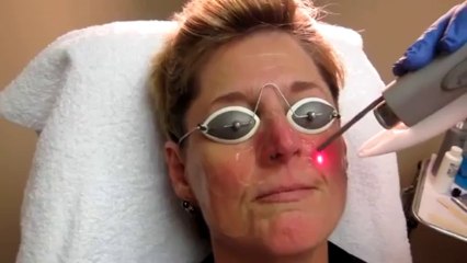 Rosacea Treatment-Los Angeles-Orange County-Riverside-Pasadena-Anaheim-Fullerton-Whittier-Covina