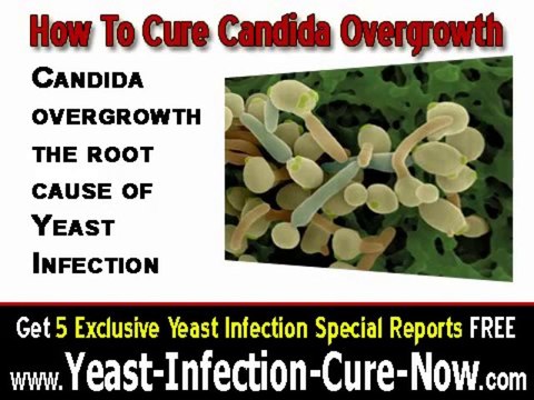 How To Cure Candida Overgrowth