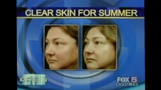 Aspire Drmatology - Getting Rid of Acne and Rosacea