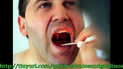 Remedio para los calculos amigdalinos