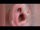 Man implants 'invisible headphones' in ears