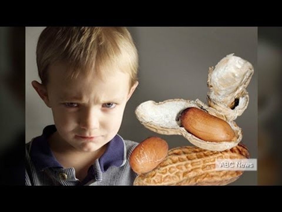 'Peanut Patch' could cure peanut allergies in children