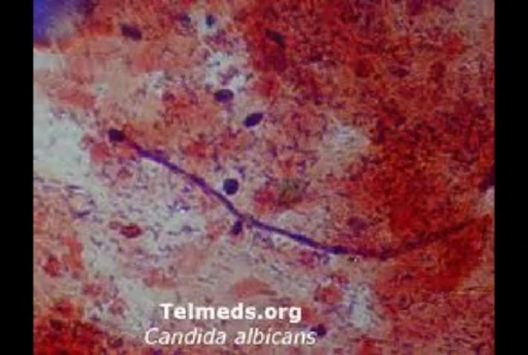How To Cure Candida
