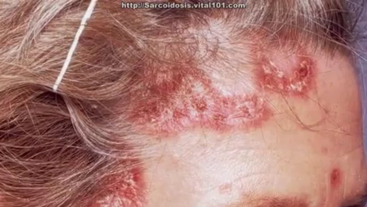 Sarcoidosis Natural Treatment - Natural Remedies For Sarcoidosis - Sarcoidosis Remission