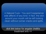 best angular cheilitis overnight cure