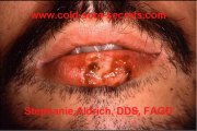 Herpes Answers- How To Get Rid of Cold Sores Fast!