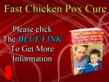 Fast Chicken Pox Cure - How to Cure Chicken Pox Naturally at Home
