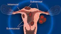 Como Curar Fibromas - Tratamiento natural para los fibromas uterinos