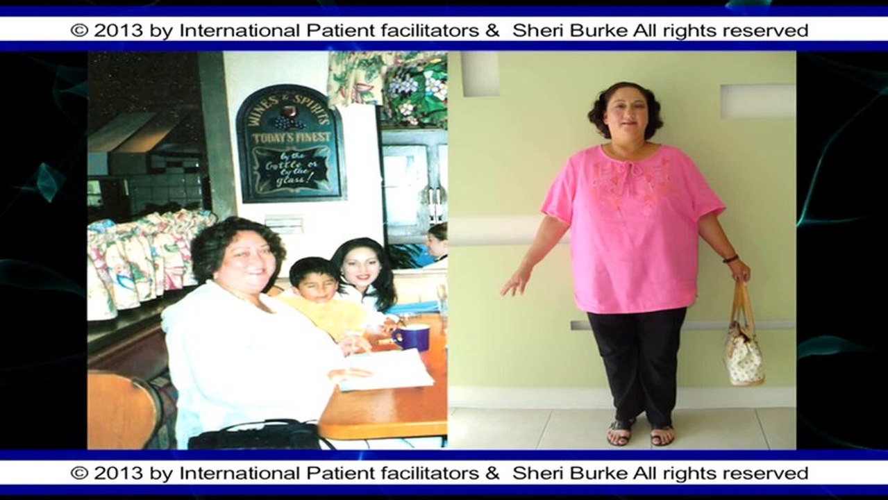 Before and After Weight Loss Gastric sleeve Tijuana, Dr. Sergio Verboonen by Sheri Burke