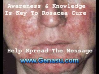 Cure For Rosacea