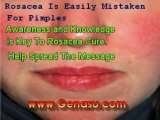alternative treatments for rosacea