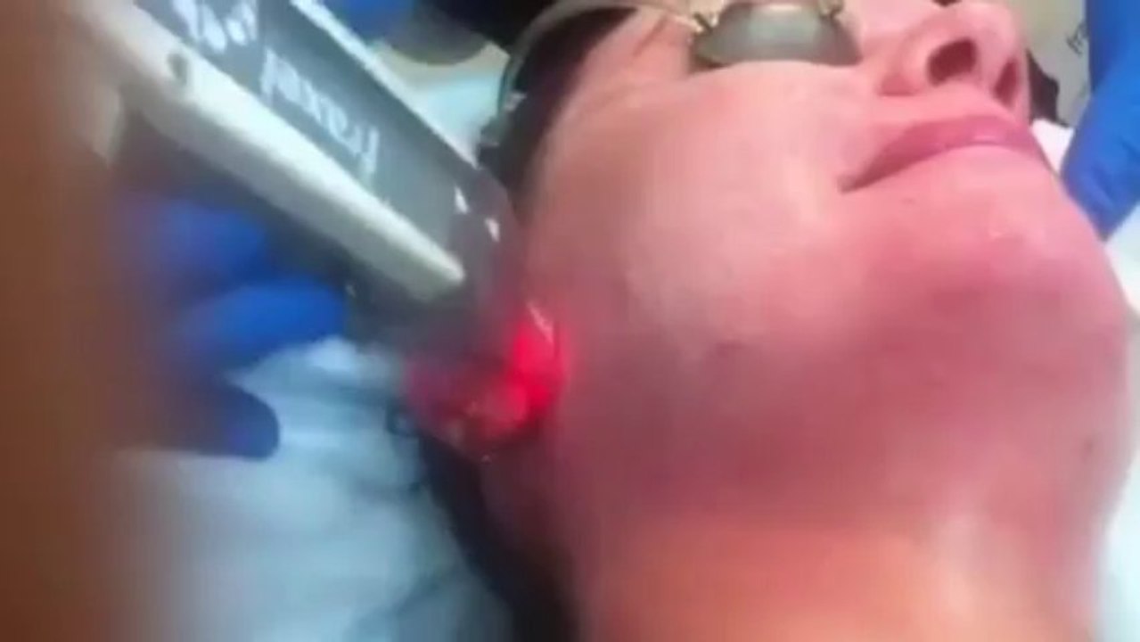 Sydney Fraxel Restore Repair lasers pigment, scars, rosacea, sun damage treatments Sydney