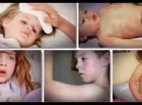 Get Rid Of Hives - Urticaria Hives Treatment - New