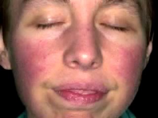 Acne Rosacea Erythema Telangiectatic