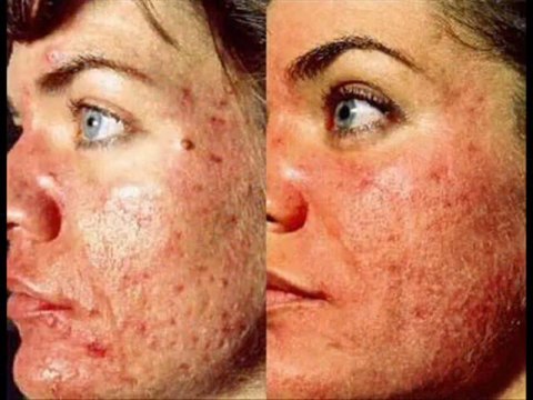 HERPES CURE NATURALLY- HERPES ANTIDOTE 100%