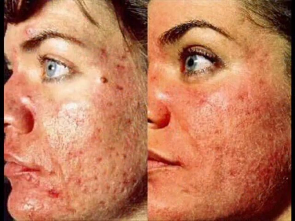 HERPES CURE  NATURALLY- HERPES ANTIDOTE 100%