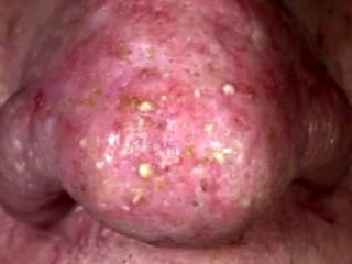 Acne Rosacea Nose Phymatous