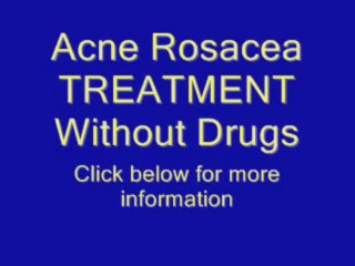 Acne Rosacea Treatment Without Drugs