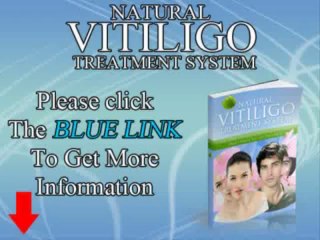 How To Cure Vitiligo Fast Naturally - Tips to Cure Vitiligo Without Medication