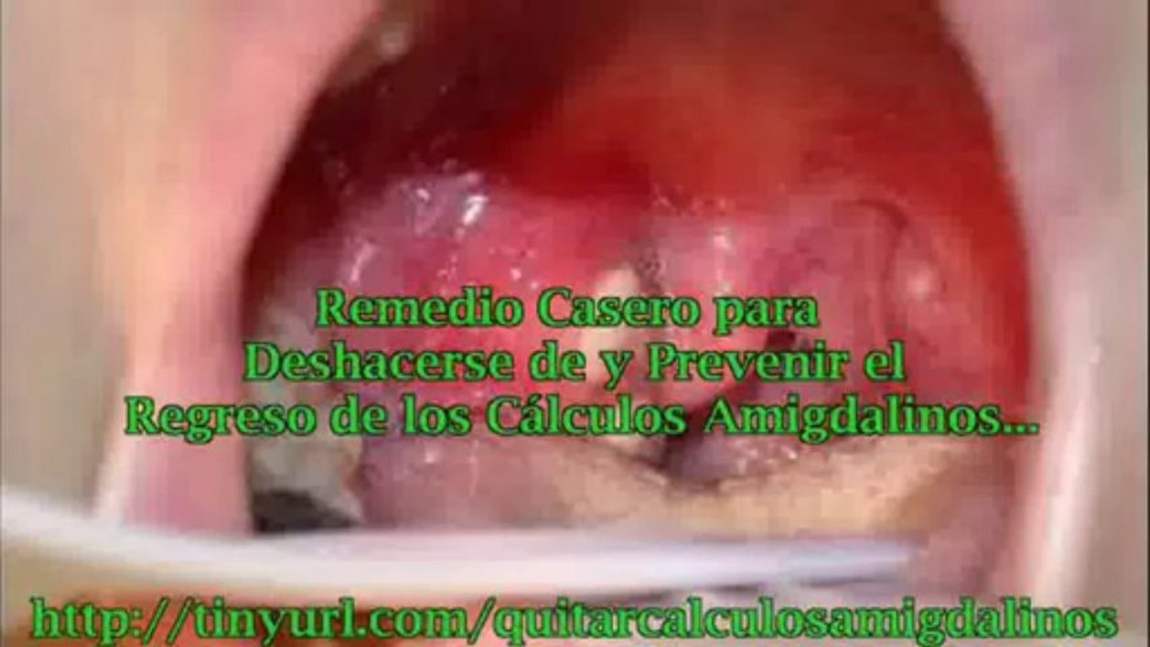 Remedios secretos caseros para los calculos amigdalinos 