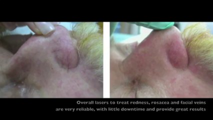 Lasers for Redness, Rosacea & Veins | Dermatologist Brandith Irwin M.D. Skintour.com