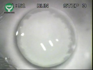 Corneal Collagen Cross Linking (CxL)