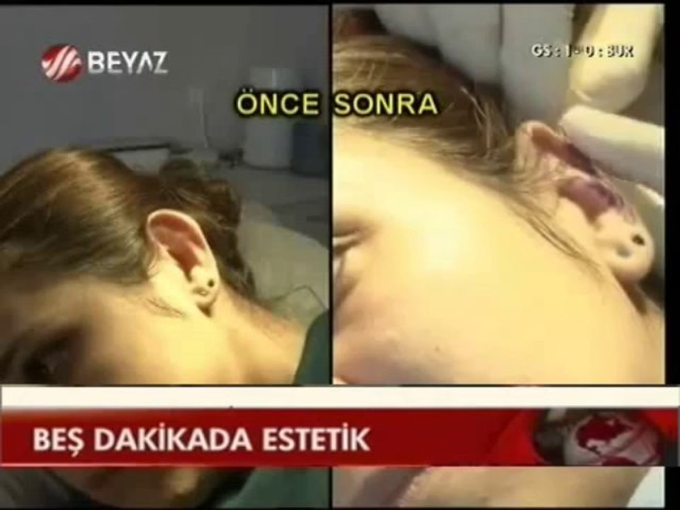 Op Dr Mustafa Ali YANIK Ameliyatsız Burun Estetiği ve Kulak Estetiği