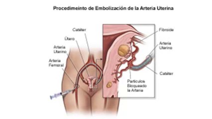 Qué Son los Fibromas - Curar Fibromas - Tratamiento Fibromas
