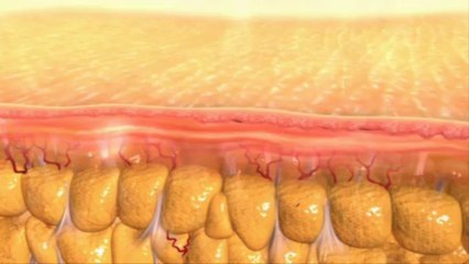 Velashape-Body-Sculpting-Winter-Park-Fl