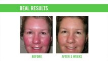 Rosacea Treatment | WHY this PROVEN ROSACEA TREATMENT is YOUR ANSWER!