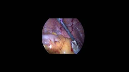 Laparoskopi ile Over kist eksizyonu 2 - Prof. Dr. Aydan Biri