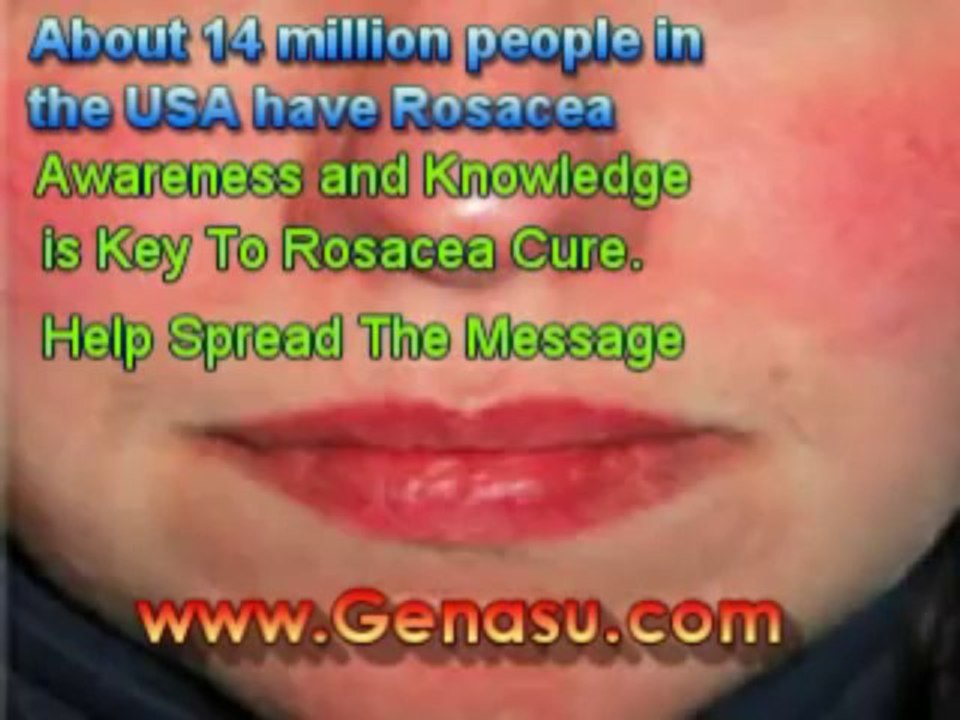 ayurvedic rosacea