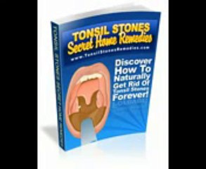 Tonsil Stones Secret Home Remedies Review + Bonus