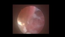 Diagnostik laparoskopi (arkuat uterus) - Prof. Dr. Aydan Biri