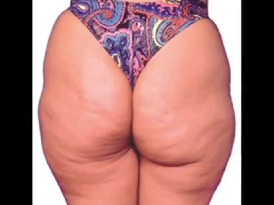 Celulite nunca mais,A única cura permanete para a celulite,como acabar com a celulite