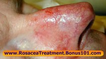 rosacea treatments - treatments for rosacea - papulopustular rosacea