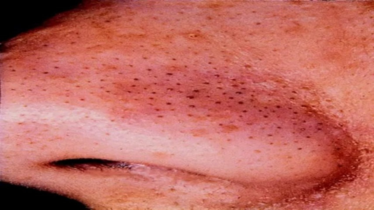 How to get rid of acne overnight- Overnight Acne cure