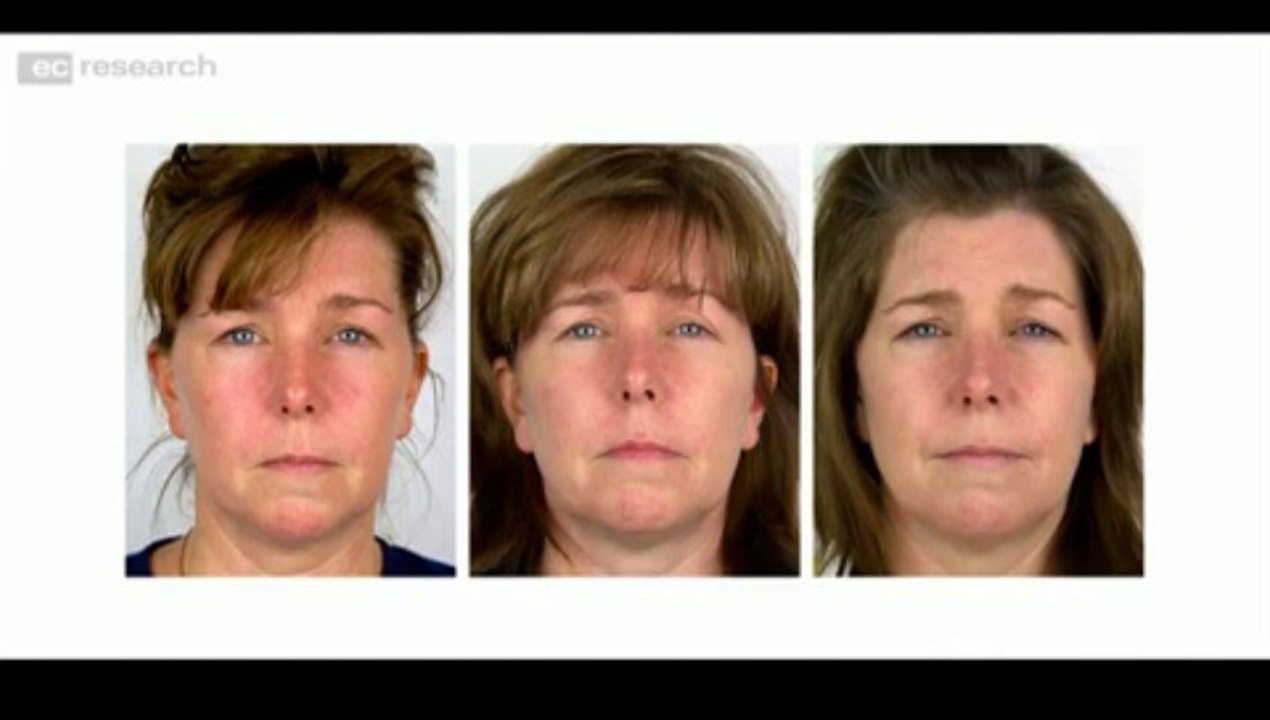 ProPLEXIN® System 2 For Rosacea Commercial