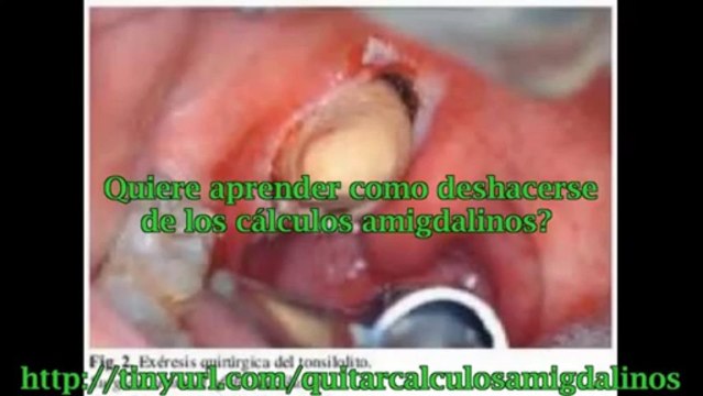 Remedios Para Los Calculos Amigdalinos