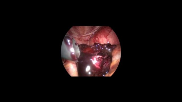 Laparoskopi ile Ektopik gebelik operasyonu, tüp ligasyon 2 - Prof. Dr. Aydan Biri