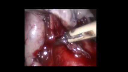 Laparoskopi ile Ovarial kist eksizyonu 3 - Prof. Dr. Aydan Biri