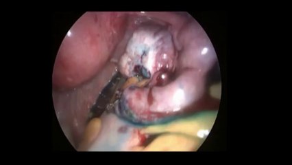 Diagnostik Laparoskopi 2 - Prof. Dr. Aydan Biri