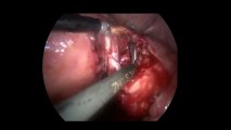 Laparoskopi ile Endometiroma 2  - Prof. Dr. Aydan Biri